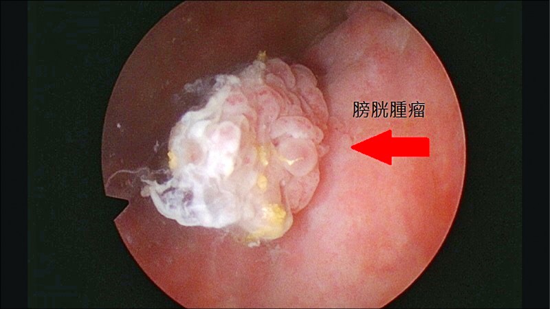 男無痛性血尿超音波揪出膀胱癌 銀髮天地 自由健康網
