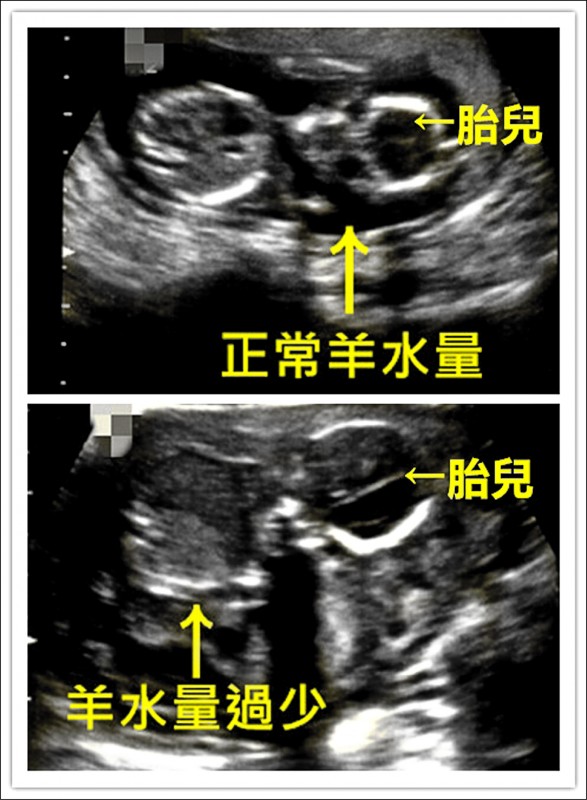 羊水過少高齡孕婦忍痛終止妊娠 自由健康網