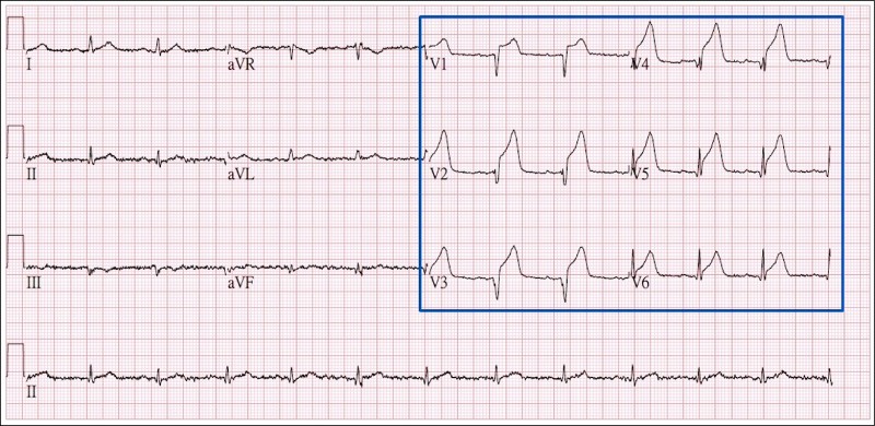 連2年心肌梗塞12導程心電圖機及時救命 即時新聞 自由健康網