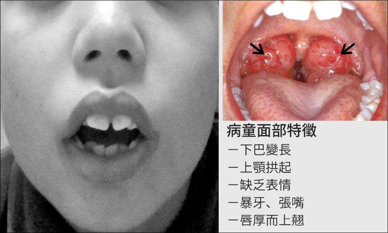 睡眠呼吸中止症干擾小一童 個小 學不好 即時新聞 自由健康網