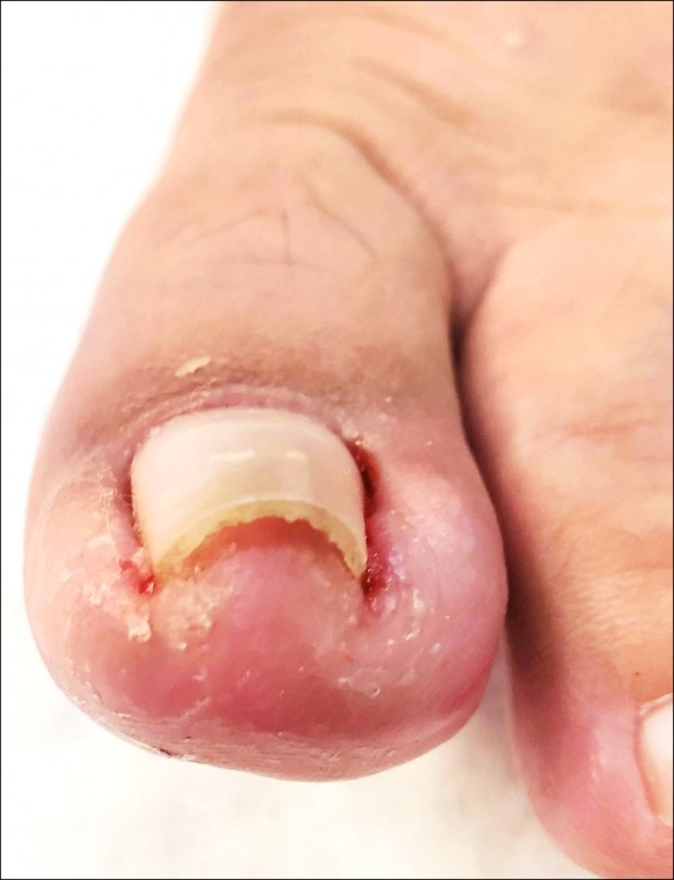 凍甲趾甲修短短當心長彎刺肉更嚴重 即時新聞 自由健康網