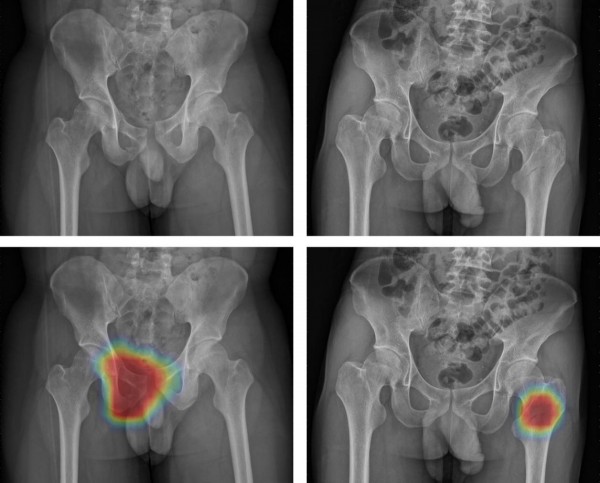 工人意外高處跌落半休克ai熱點電腦視覺找到骨盆骨折 即時新聞 自由健康網