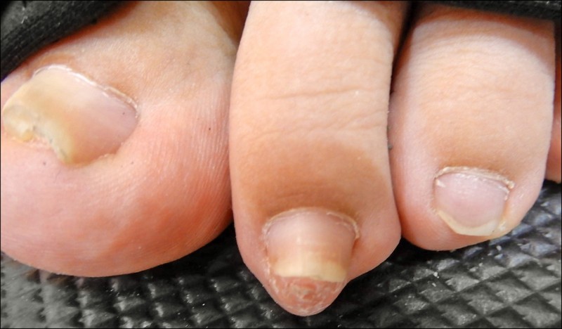 腳趾頭突出一塊確診外生骨疣 美顏抗老 自由健康網