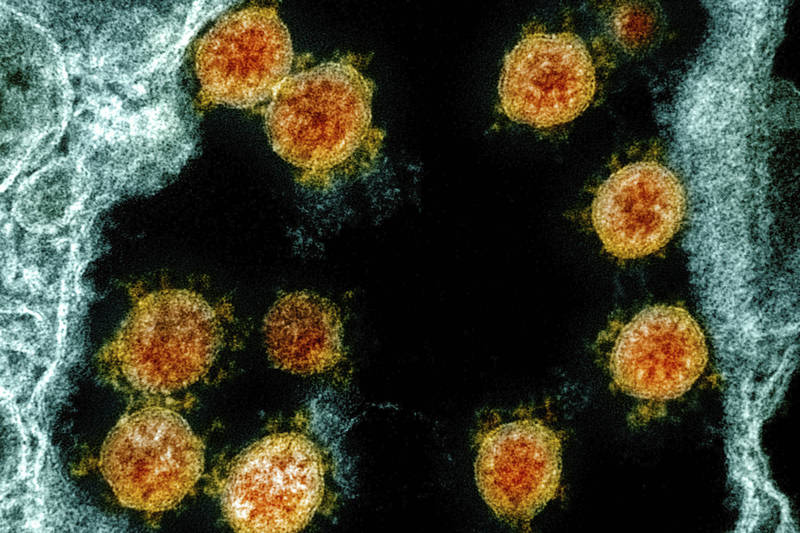 将全球病患所携带的武汉肺炎致病病毒SARS-CoV-2（见图）颗粒质量加总，总重量约为100公克至10公斤，重量介于一颗苹果与一个幼儿之间。（美联社）(photo:LTN)
