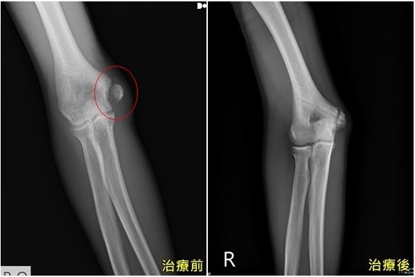 投手改練外野傳球過猛手肘骨折手術用可吸收式骨釘助提早回球場 即時新聞 自由健康網