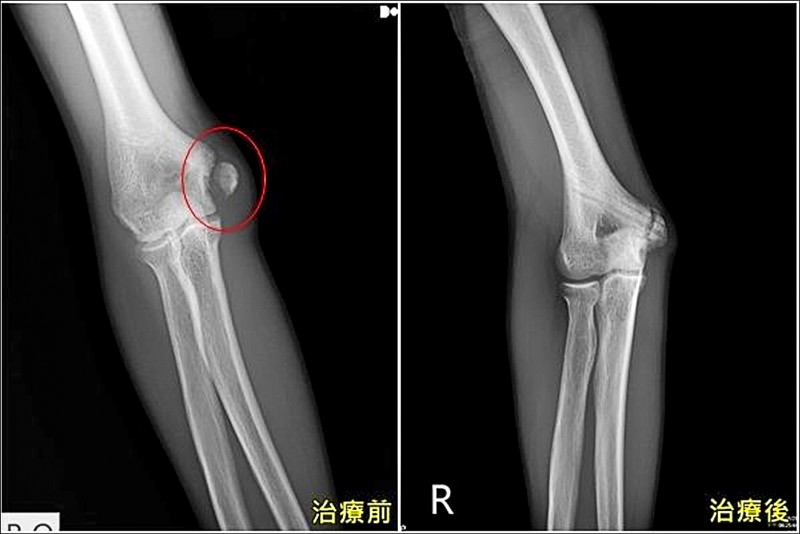 傳球過猛青少棒投手手肘撕脫骨折 即時新聞 自由健康網