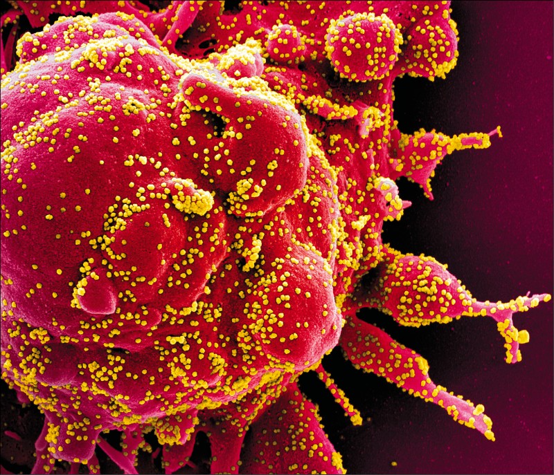 一名中国研究人员去年曾要求美国国家卫生研究院删除其提交的资料数据，包括去年一至二月间在武汉採集的武汉肺炎住院患者或疑似病例的病毒基因序列。图为从一名武肺患者体内採集的凋亡细胞（apoptotic cell），在遭SARS-CoV-2病毒感染后的电子显微镜照片。（路透档案照）(photo:LTN)