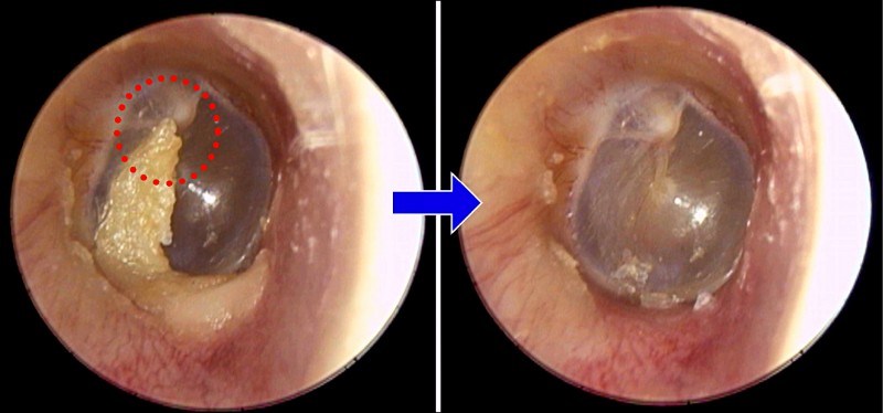 棉花棒掏耳掏出耳垢栓塞症候群 即時新聞 自由健康網