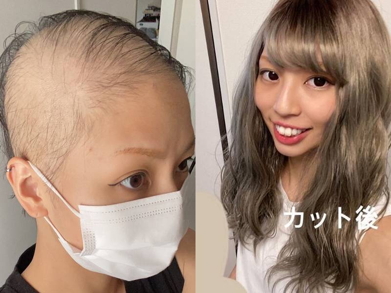 女子在7月31日已接近全秃（左），外出时会带上假发（右）。（图取自部落格「Ameba」、「Instagram」）(photo:LTN)
