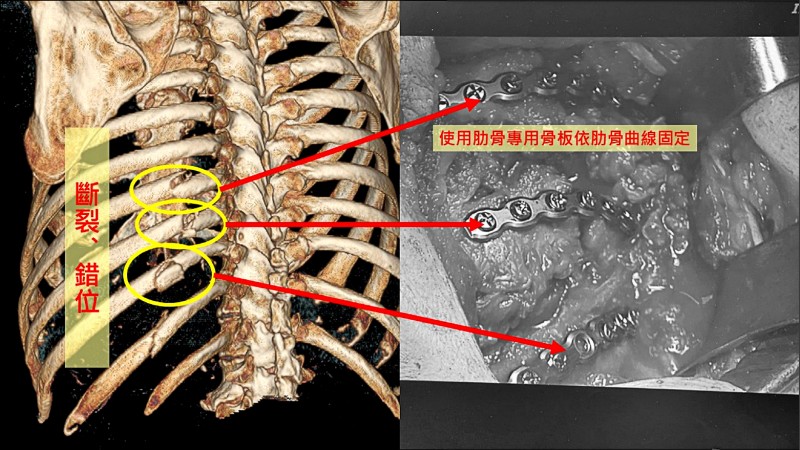 94歲翁肋骨骨折劇痛 骨板固定術 一週就出院 銀髮天地 自由健康網