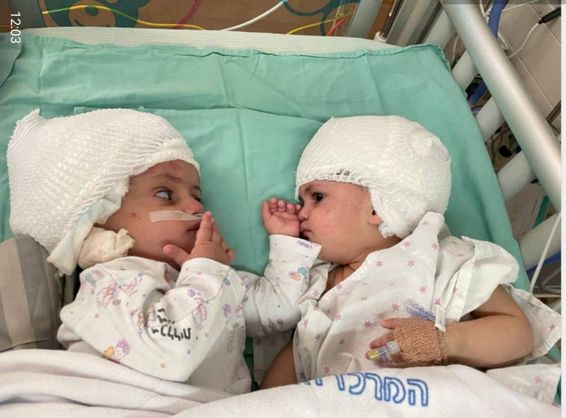 以色列一對雙胞胎連體嬰（見圖）以後腦勺連接，經歷漫長的手術後，她們終於成功能面對面相見歡。（路透）