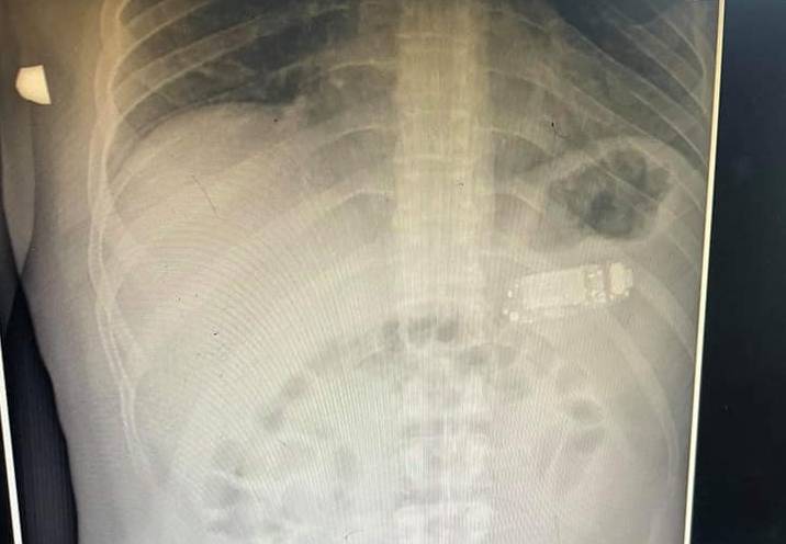 科索沃一名男子無故吞下Nokia 3310手機，4天後因腹部劇痛就診，醫生一看X光片都傻眼。（翻攝自Facebook @Skender Telaku）