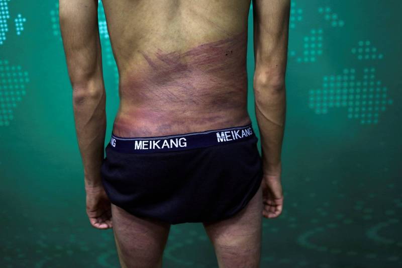图中可清楚看见1名男子背部及大腿有大片红色伤痕。（路透）(photo:LTN)