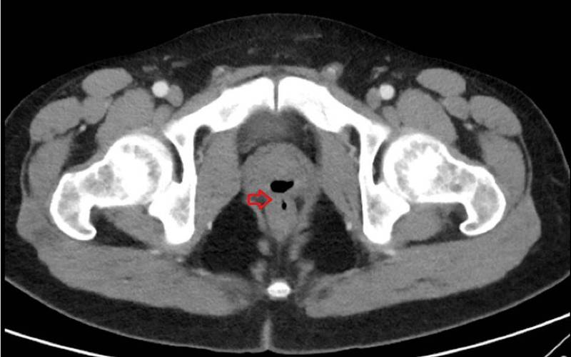 断层扫描显示，该名男子的直肠与尿道之间有一种称为「瘘管」（箭头处）的异常通道。（图翻摄自Cureus网站）(photo:LTN)