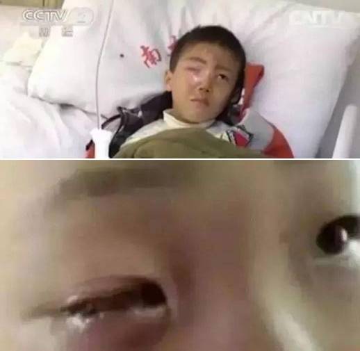中國上海市一名8歲男童獨自吃零食，見乾燥劑產生好奇心，把乾燥劑丟進飲料中，右眼遭鹼性液體噴濺，眼球「整個被溶解」失明。（翻攝中媒沈陽晚報）