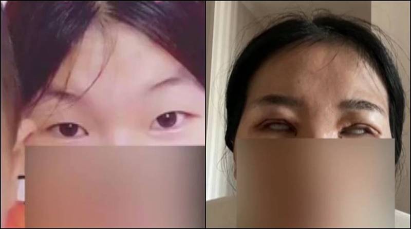 割完雙眼皮被罵「怪物」!她崩潰爆哭:老公要和我離婚 1