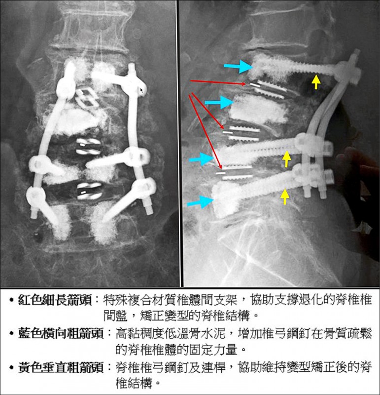 健康聚寶盆 脊椎手術日新又新百歲嬤重拾樂齡生活 銀髮天地 自由健康網