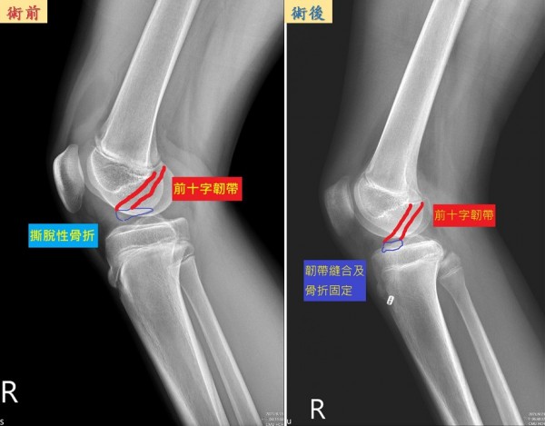 解封後學生運動骨折增多醫3點提醒 即時新聞 自由健康網 解封後學生運動骨折增多醫3點提醒 即時新聞 自由健康網