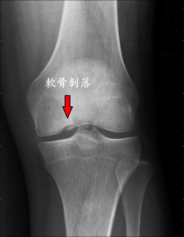 膝蓋異常疼痛小心軟骨骨折 即時新聞 自由健康網