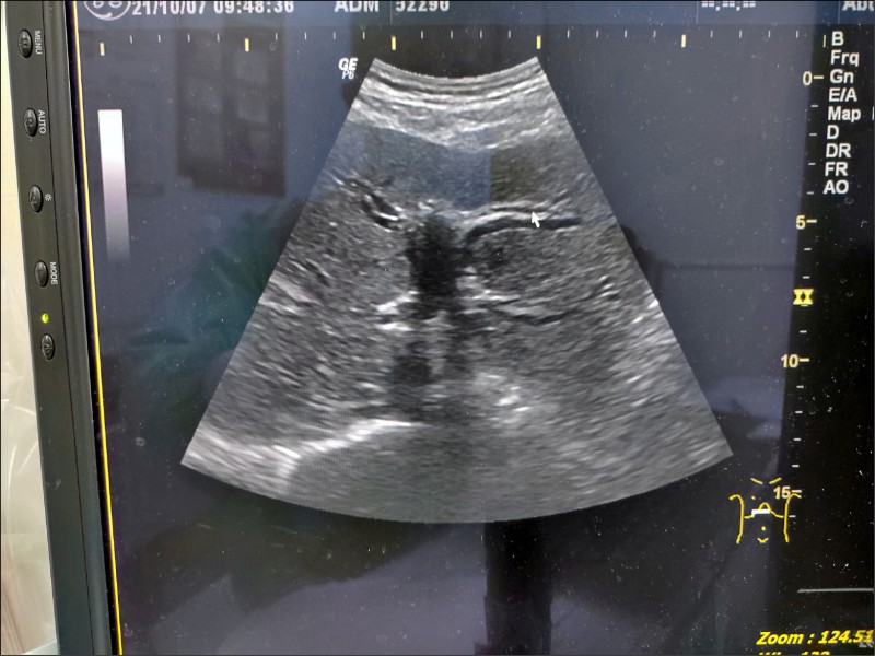 上腹悶痛又黃疸竟是十二指腸腺癌 即時新聞 自由健康網