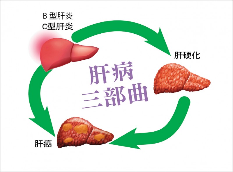 愛肝加油站 肝炎演變肝纖維化 肝硬化肝癌風險升高 即時新聞 自由健康網
