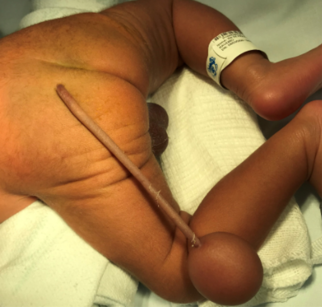 巴西1名新生儿股竟然长着1条细长尾巴，末端还有1颗超萌肉球。（图取自《儿科手术病例报告期刊》Journal of Pediatric Surgery Case Reports）(photo:LTN)