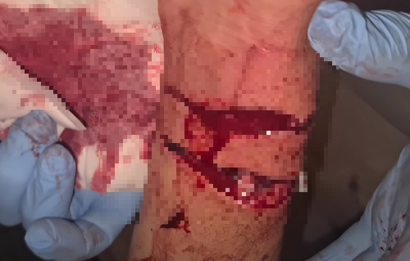 保育员的一条动脉完全被咬成两段，这是院方看过最严重的蛇类咬伤伤口。（撷取自WILD YouTube）(photo:LTN)