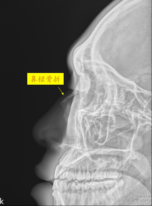 型男運動員撞歪鼻子微創閉合復位重建正鼻 自由健康網