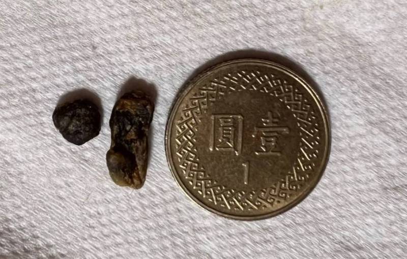 曾因巨大耳屎上新聞 8年後再挖出「耳石」 1 phpt4Kqao