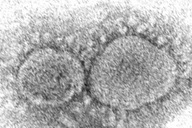莫德納首席醫療官伯頓示警，未來若有患者同時感染Omicron和Delta，2種變異株很可能會在感染細胞中交換基因，進而衍生另一種新型超級變種病毒。示意圖，圖為電子顯微鏡下的武肺病毒粒子。（美聯社）