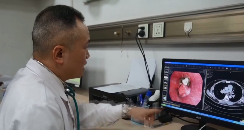 中国武汉一名张先生不慎把一截鸭脖子骨头吸进左肺里，碍于当时中国医术水准，这块骨头卡在身体里20年，长期下来严重影响健康。（翻摄微博）(photo:LTN)
