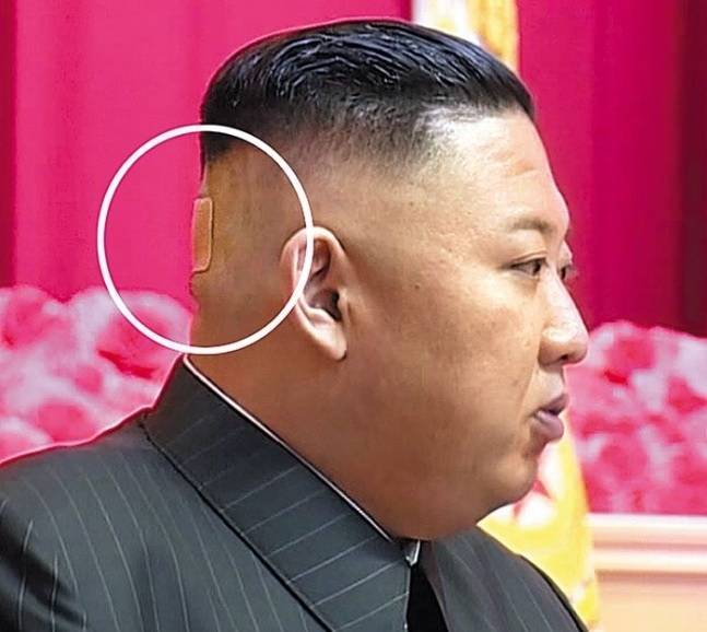金正恩上月24日至27日主持北韩首次全军指挥官、政治干部培训时，被拍到后脑勺上贴着巴掌大小的「膏药」（左白圈处）。（翻摄自北韩中央电视台画面）(photo:LTN)