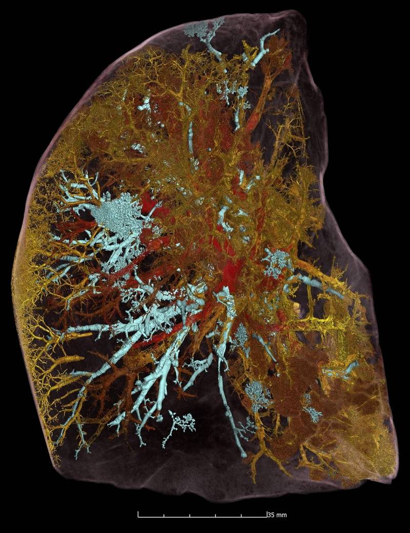 透过HiP-CT的效果，可以看到这名死者肺部损伤细节，其中肺泡和唿吸性细支气管是蓝色，开放的血管是红色，而染疫后被闭塞和损坏的血管是黄色。（图取自伦敦大学官网）(photo:LTN)