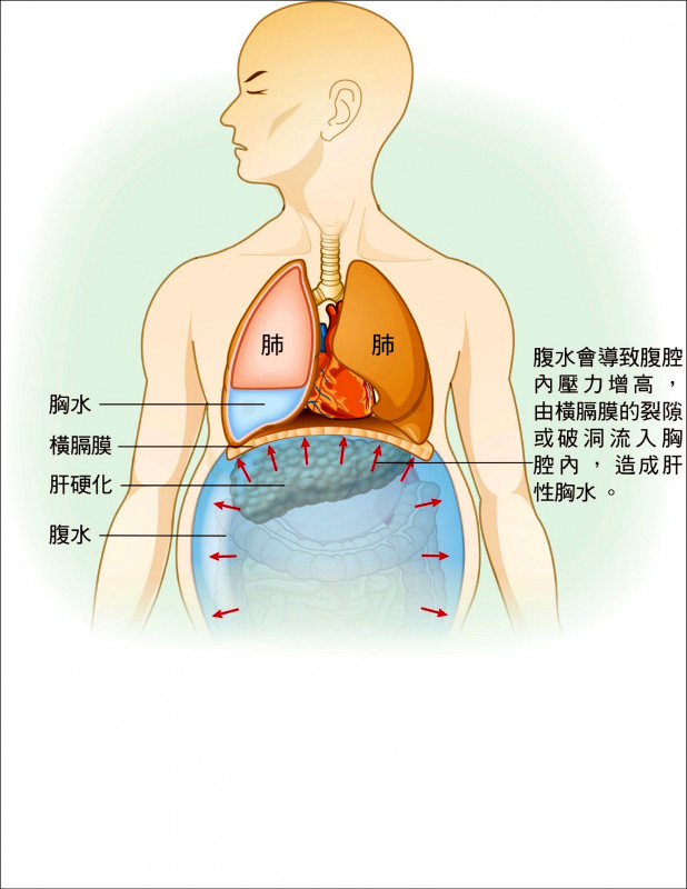 愛肝加油站 肝癌病患腹水太多恐引起肝性胸水 即時新聞 自由健康網