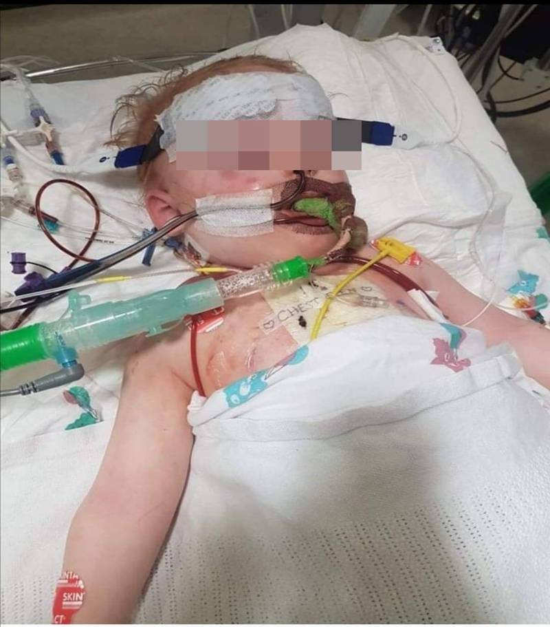 誤食玩偶鈕扣電池1歲半男嬰心臟燒破洞、肺衰竭- 國際- 自由時報電子報