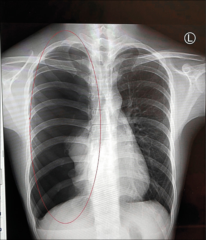 男大生胸部有點悶竟是大片氣胸 即時新聞 自由健康網