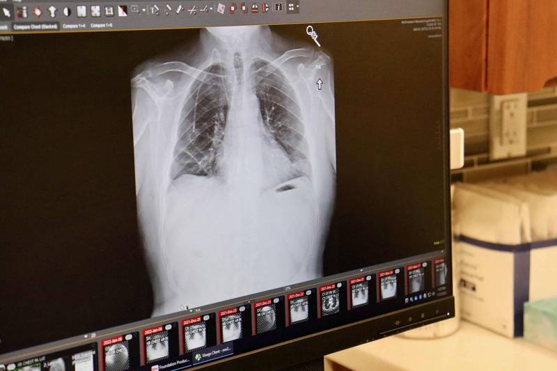 西北大学医学院附属医院今年1月拍摄末期肺癌患者库里移植的新肺状况。（法新社）(photo:LTN)
