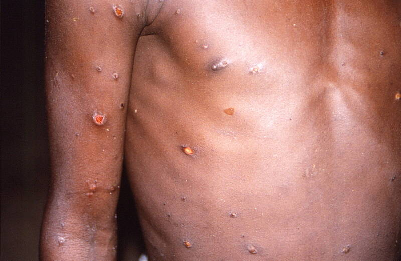 近日歐美國家出現「猴痘」感染案例，世界衛生組織20日聲明，目前已確認的案例約80例，分佈在11個國家。猴痘症狀示意圖。（路透）