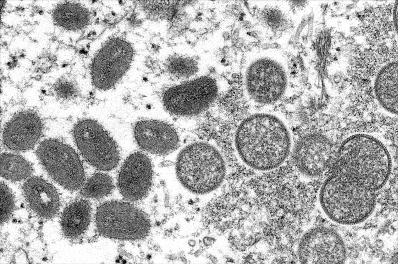 歐美傳出猴痘疫情，圖為猴痘病毒粒子。
（美聯社）