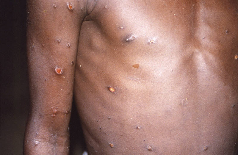 北美和歐洲陸續出現猴痘（Monkeypox）病例，至今已在15國出現，引發外界擔憂。（美聯社）
