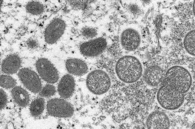 美国发现2种不同的猴痘病毒株，境内可能存在尚未被察觉的传染情况。（美联社）(photo:LTN)