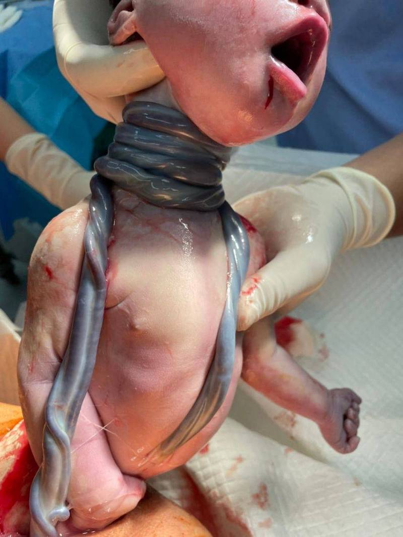 禾馨婦產科醫師林思宏分享一個接生案例，嬰兒的脖子纏上臍帶，整整繞了5圈，引起關注。（翻攝粉專「林思宏醫師」）