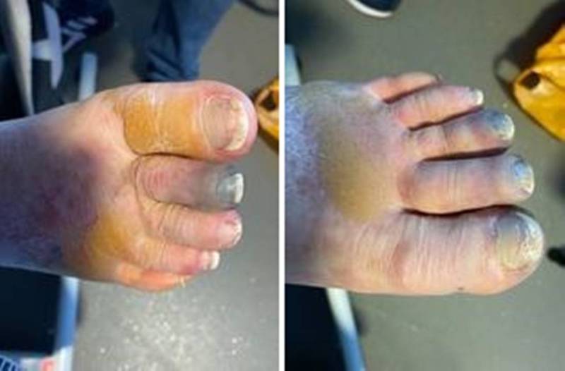 苏格兰一名51岁女子不幸在今年3月确诊武汉肺炎，重症濒危抢救回来后出现手指与脚趾发黑坏死的状况。（翻摄募款页面）(photo:LTN)