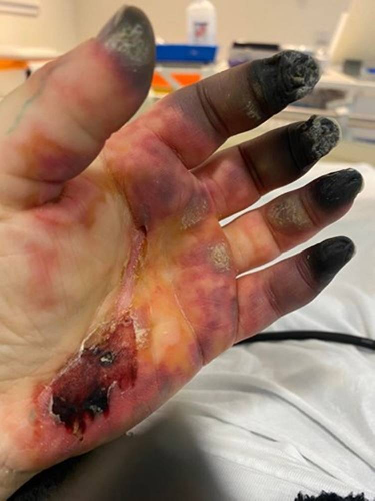 蘇格蘭一名51歲女子不幸在今年3月確診武漢肺炎，重症瀕危搶救回來後出現手指與腳趾發黑壞死的狀況。（翻攝募款頁面）