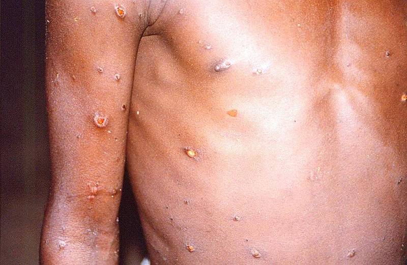 Skin lesions caused by monkeypox cover the arms and torso of a person in an undated image taken during an outbreak of the virus in the Democratic Republic of the Congo from 1996 to 1997.
Photo: Reuters