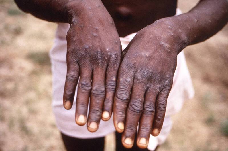 猴痘（monkeypox）是猴痘病毒家族的不同演化分支，以非洲地区命名，备受争议。图为1996至1997年间在刚果民主共和国调查疫情时拍摄。（路透资料照）(photo:LTN)