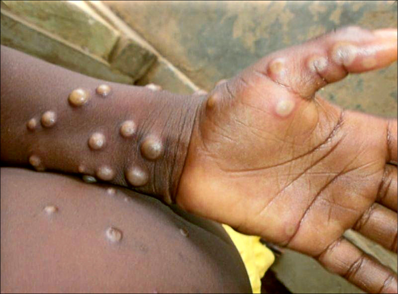 專家表示，勤洗手、攜帶酒精消毒、戴口罩，可有效預防猴痘。（資料照，翻攝自世衛組織官網）