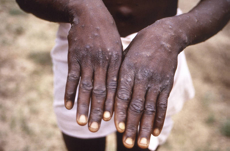 法國衛生單位通報首例兒童猴痘。（法新社）
