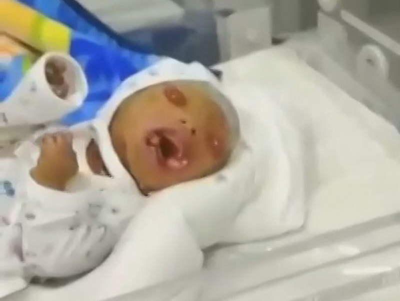 烏茲別克有名出生即罹患罕見疾病的男嬰，是因為男嬰的父母為「兄妹亂倫」，在出生2小時又10分鐘就不幸夭折。（圖擷取自@dailystar推特）