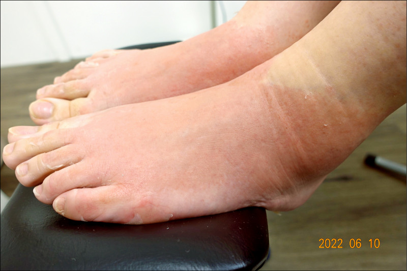 足膜敷太久灼傷雙腳ol急救3天 即時新聞 自由健康網